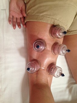 Benefits of Cupping for Your Health